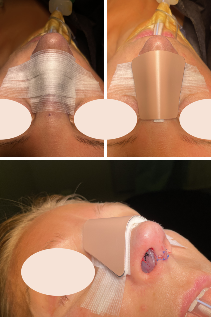 Rhinoplastie à Lille - déroulement de l’intervention avec le Dr Julie Isquierdo